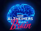 Here's how Alzheimers affects the brain as the condition progresses.