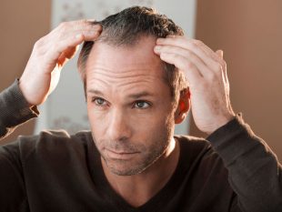 How to stop hair loss to keep from going bald