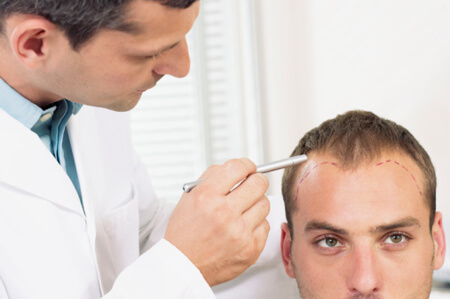 doctor outlining hair loss on man's head